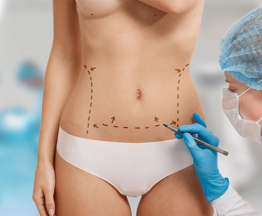 Tummy Tuck